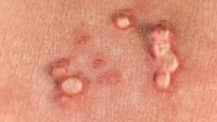 تشخیص و درمان ویروس HPV