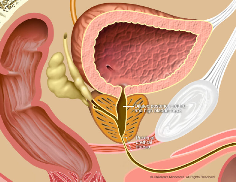 Diagnosis and treatment of urinary tract obstruction