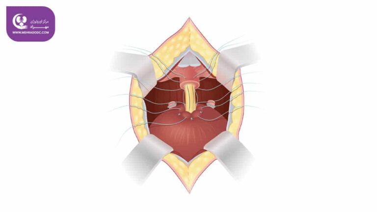 پروستاتکتومی چیست؟ همه چیز درباره جراحی پروستاتکتومی