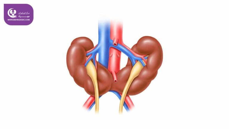 کلیه نعل اسبی یا فیوژن کلیه چیست؟