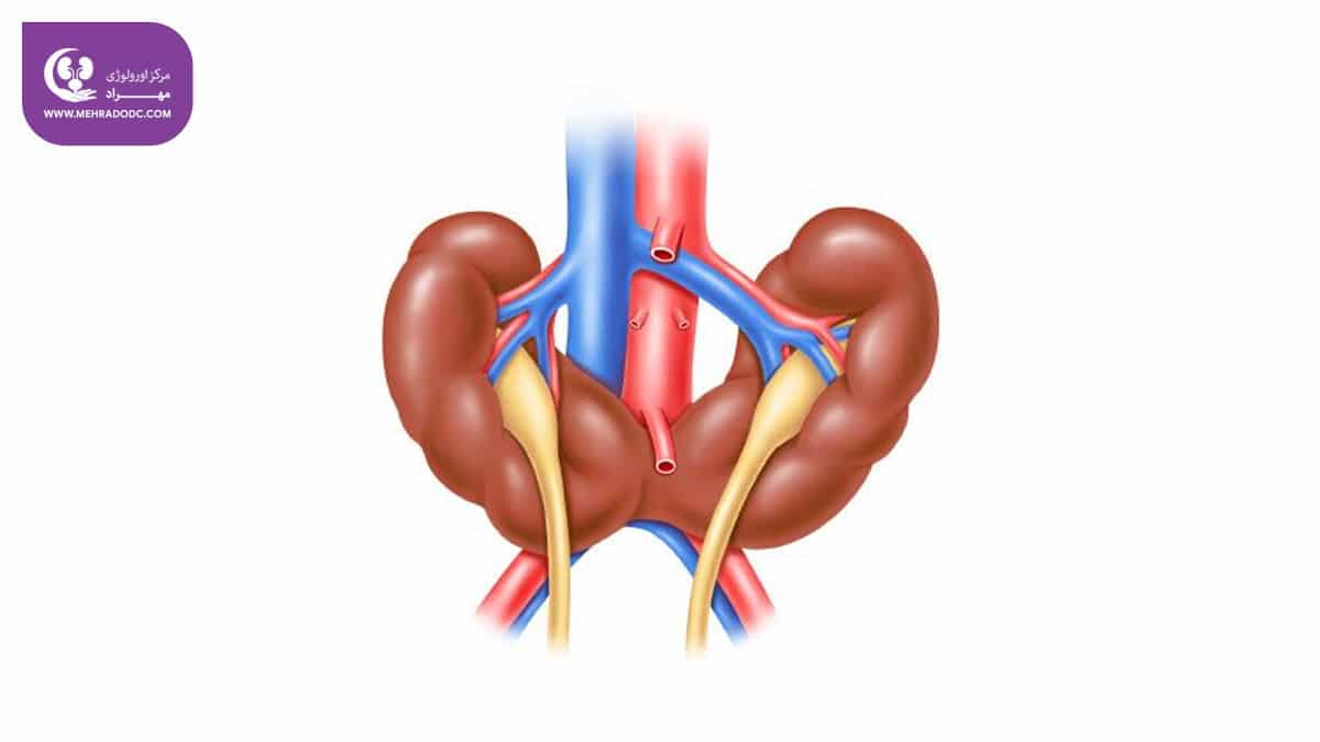 کلیه نعل اسبی یا فیوژن کلیه چیست؟